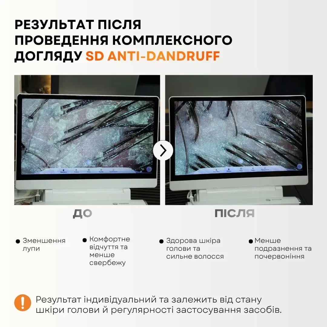 FULL FORCE SD Anti-Dandruff Scalp Lotion — лосьон для кожи головы, склонной к перхоти